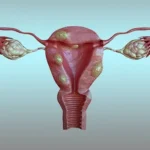 Uterine Fibroid Embolization