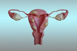 Uterine Fibroid Embolization