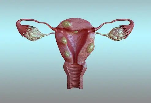 Uterine Fibroid Embolization